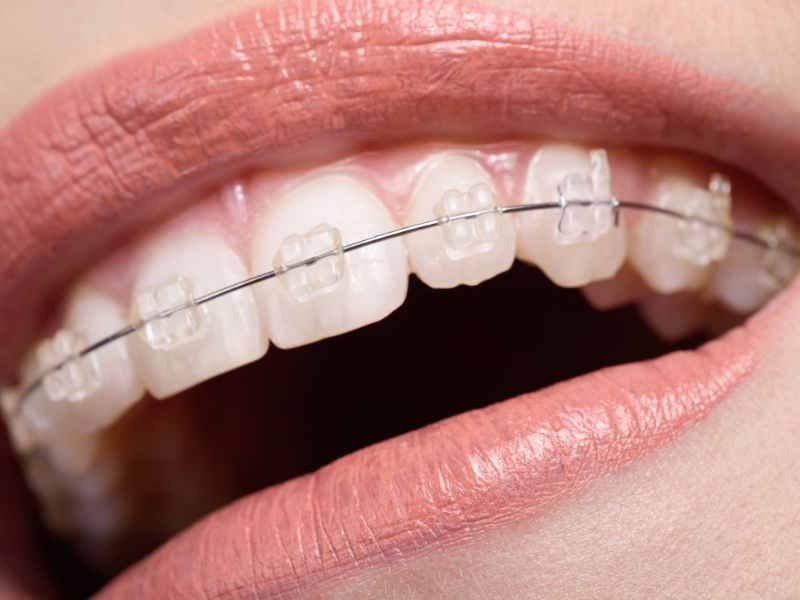 Niềng răng mắc cài pha lê