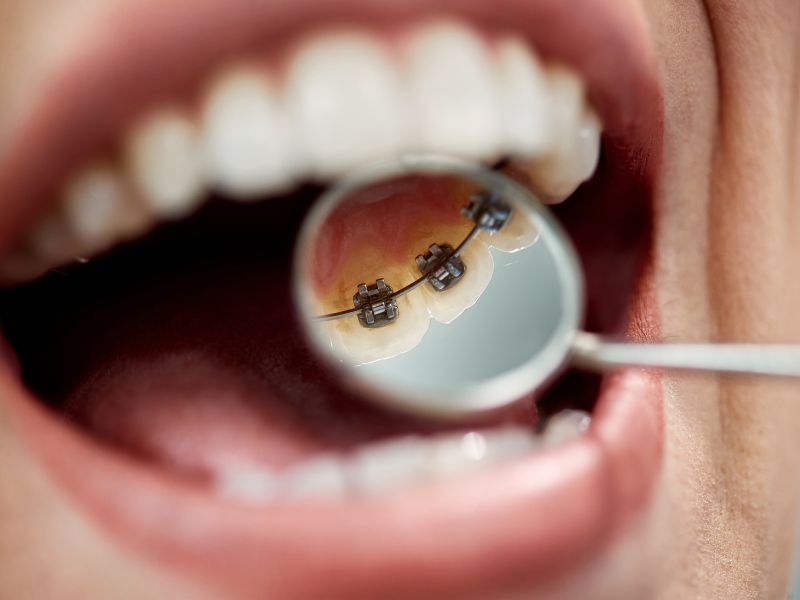Niềng răng mắc cài mặt trong