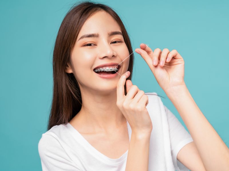 Niềng răng mắc cài