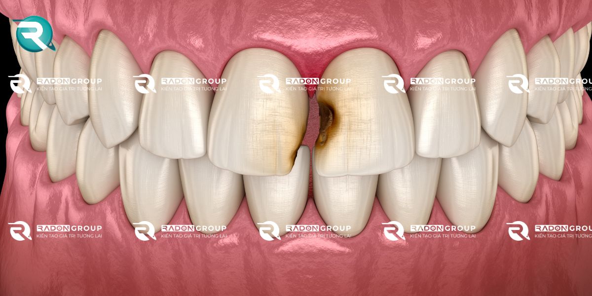 Bề mặt men răng bị tổn thương, mòn hoặc sứt mẻ nhẹ