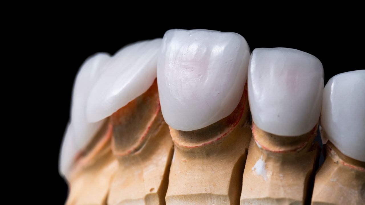 ưu nhược điểm bọc răng sứ