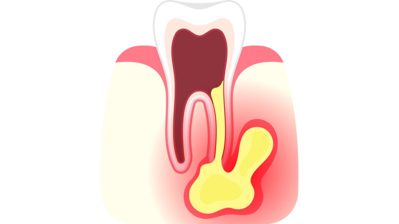 Nguy cơ viêm tủy