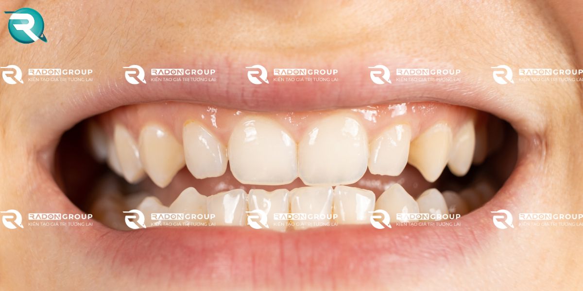 Răng bị thưa, có kẽ hở ở mức độ nhẹ đến trung bình