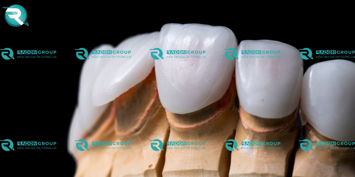 Răng tương đối đều đặn, chỉ có khuyết điểm nhỏ về hình thể