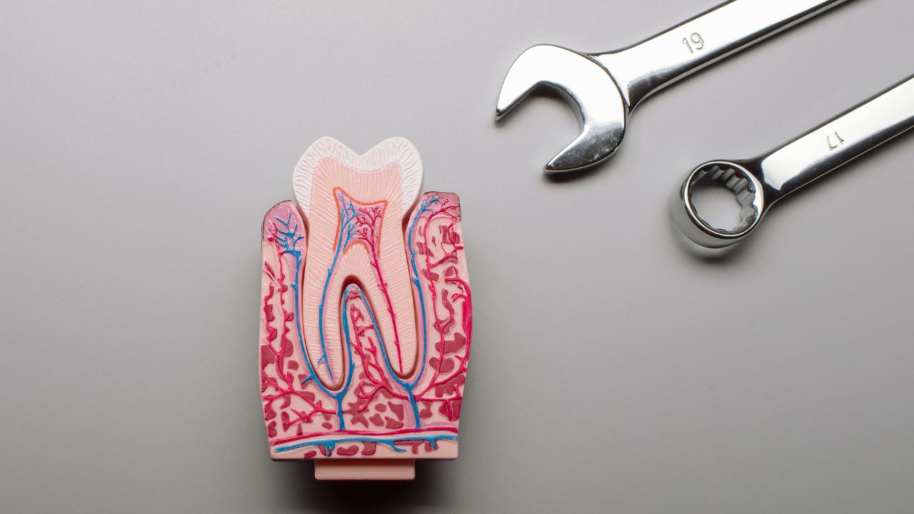 Xâm lấn cấu trúc răng thật do bắt buộc phải mài răng