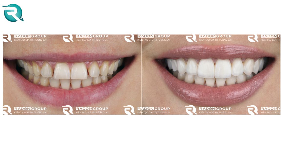 bọc răng sứ không mài