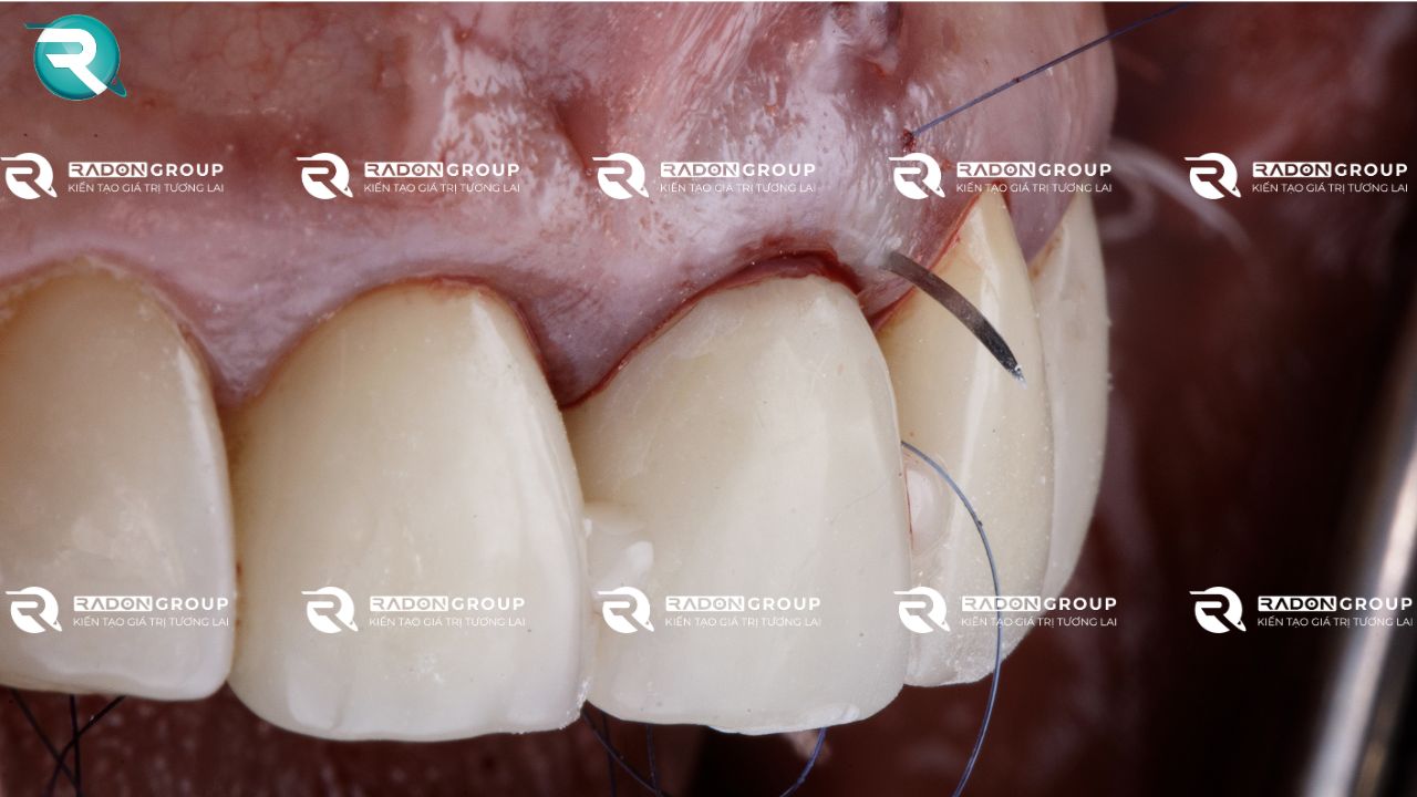 Chỉ khâu trong nha khoa