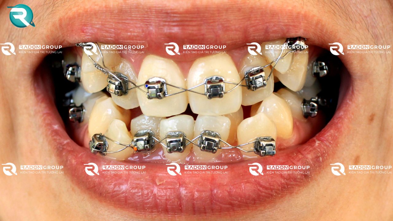 Điều trị răng chen chúc, khấp khểnh