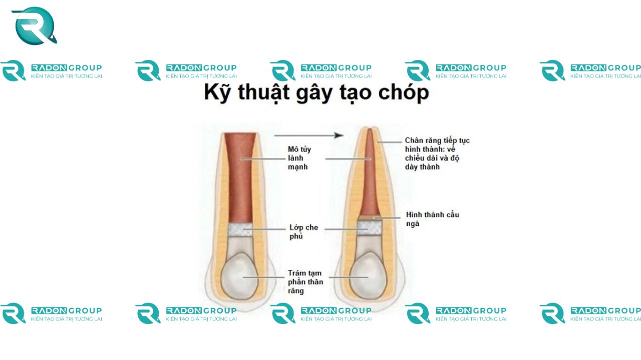 Đóng chóp (Apexification) cho răng vĩnh viễn chưa trưởng thành