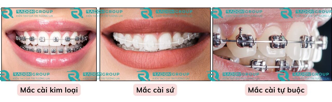 Khí cụ niềng răng cố định