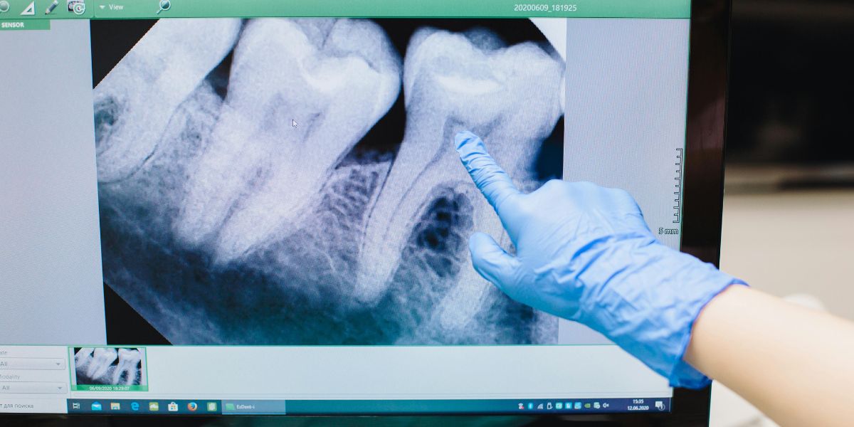 Kích thước xương hàm hẹp, không đủ chỗ cho răng