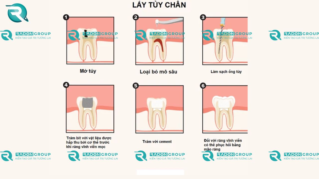 Lấy tủy buồng (Pulpotomy) ở răng sữa