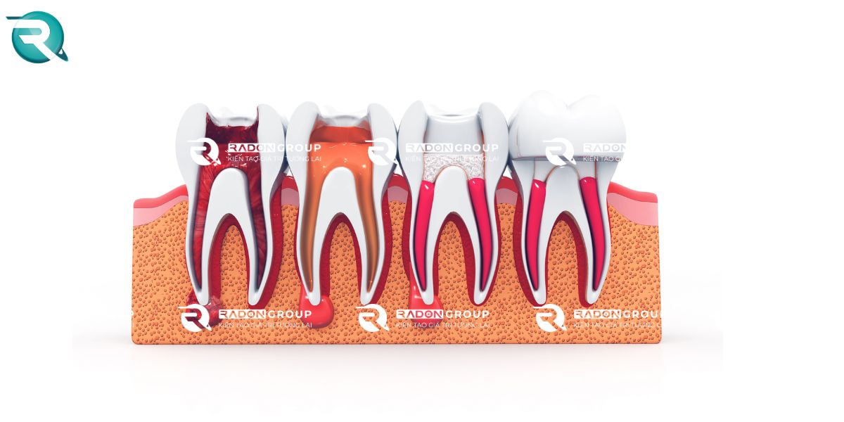 Lấy tủy răng khi mang thai