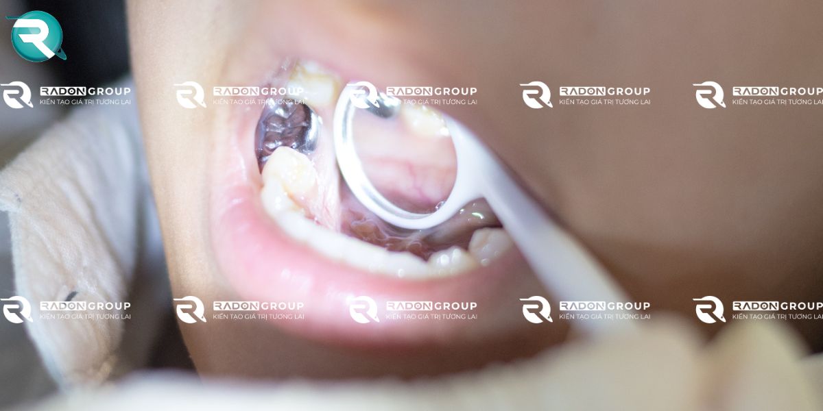 Mức độ giải phóng và hấp thụ