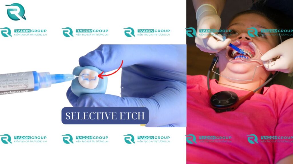 Phương pháp Selective etch
