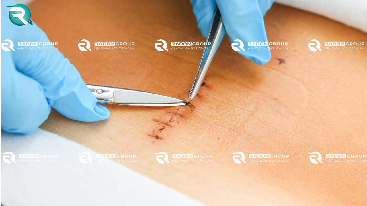 Quy trình và thời gian tháo chỉ