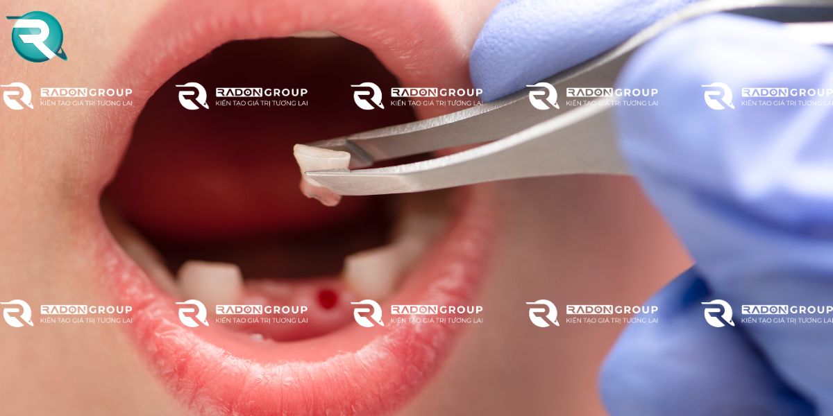 Răng sữa rụng quá sớm hoặc quá muộn