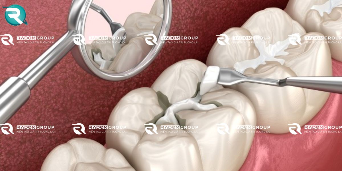 Trám răng Composite