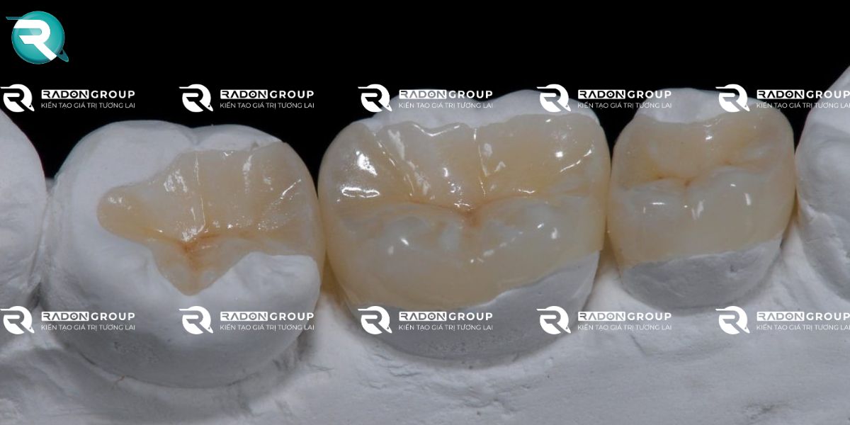 Trám răng Inlay_Onlay