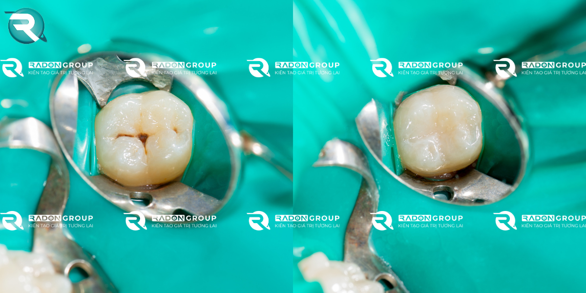 Trám răng composite là gì_ 