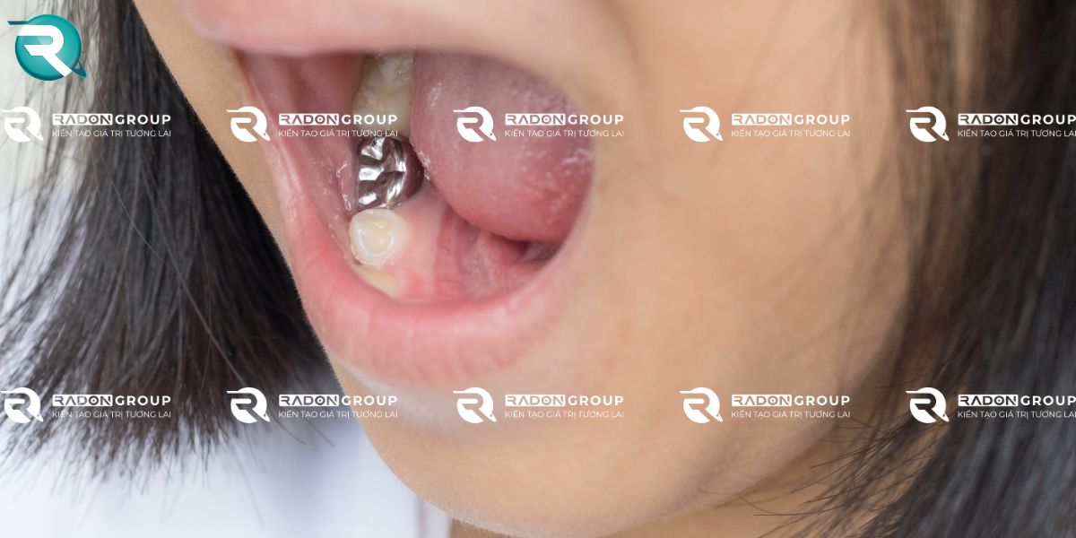 Ưu điểm trám Amalgam