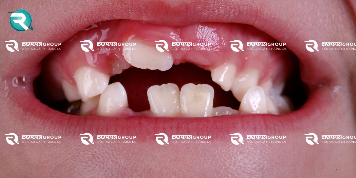 Răng sữa mọc lệch có sao không