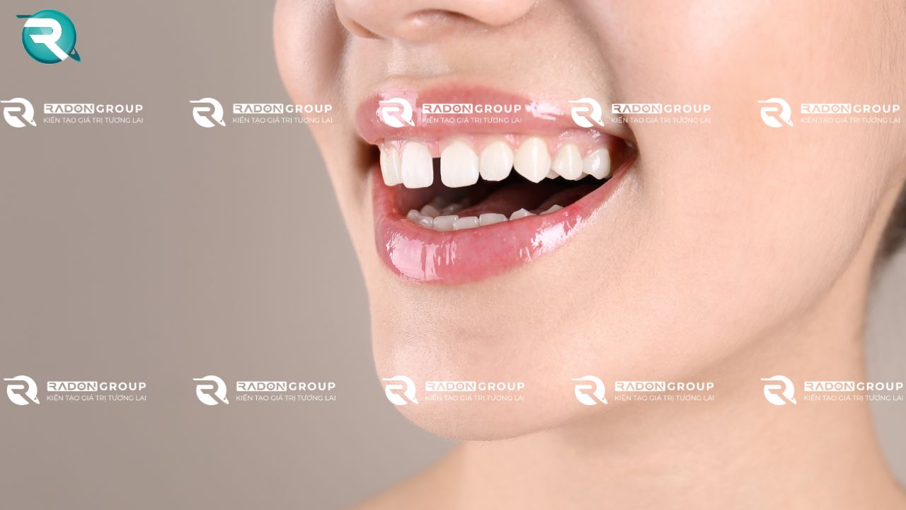 răng thưa, khe hở