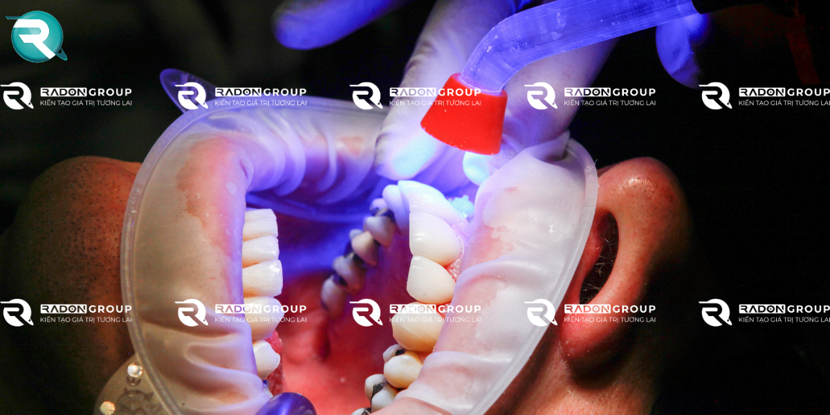 trám răng thẩm mỹ composite được ưa chuộng